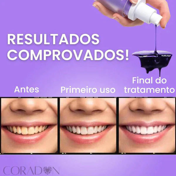 SmileEase V34 - Clareador Mágico Dental | Transforme seu sorriso em poucos dias